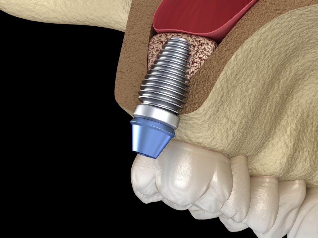 crowns-vs-dental-implants-which-is-the-best-treatment