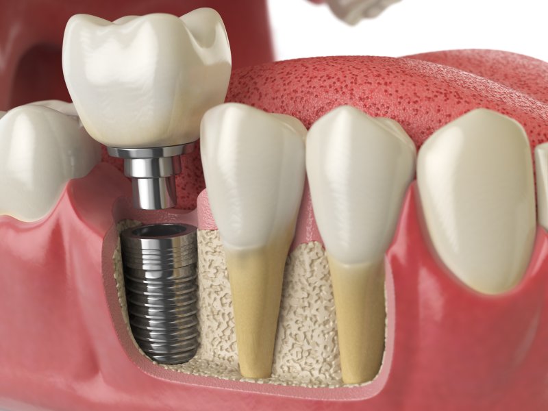 How Long Do Dental Implants Last | Salinas | Blanco Circle Dental Care